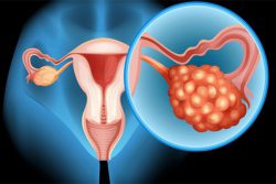 سرطان تخمدان، شایع ترین علت مرگ ناشی از سرطان های ژنیتال در خانم ها